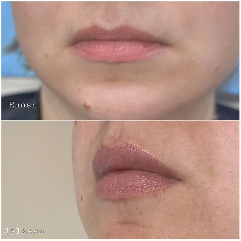 Huulten taytto ennen ja jalkeen